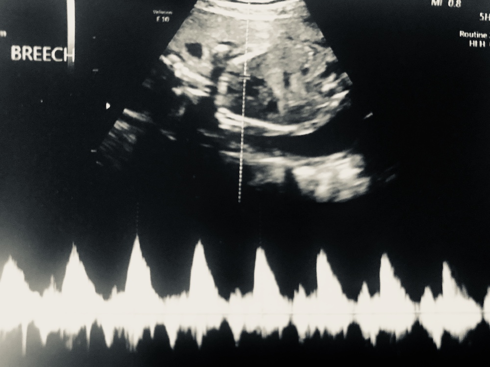 Tiny-Footprints-Blog-Fetal-Echocardiogram